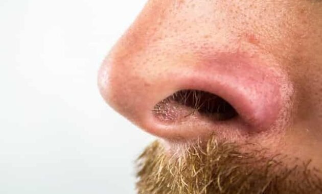 Cara Membersihkan Komedo