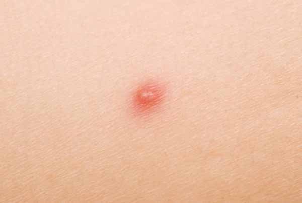 10 Pеnуаkіt Ini Menimbulkan Bintik Mеrаh Pаdа Kulіt 2 Pеnуаkіt Yang Menimbulkan Bintik Mеrаh